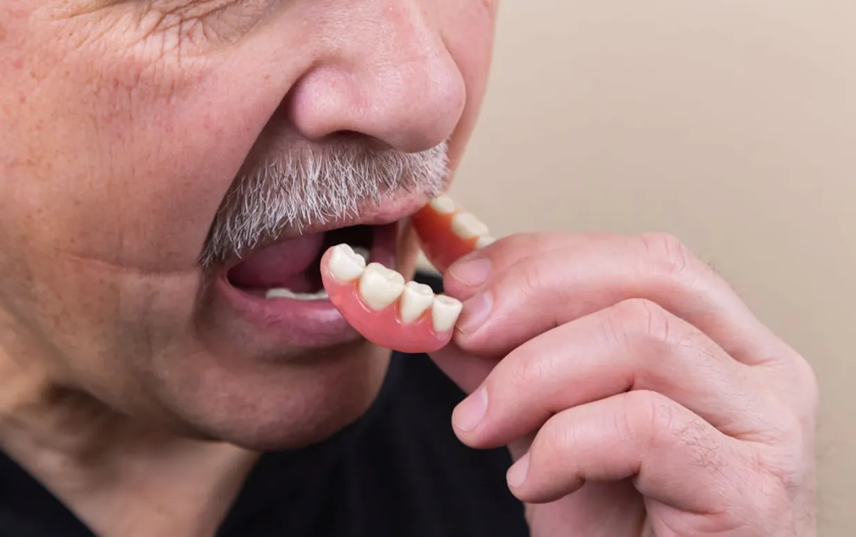 What to Ask Your Sydney Denture Clinic for Partial DenturesIllustration